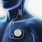 Vagus Nerve Stimulation (VNS)